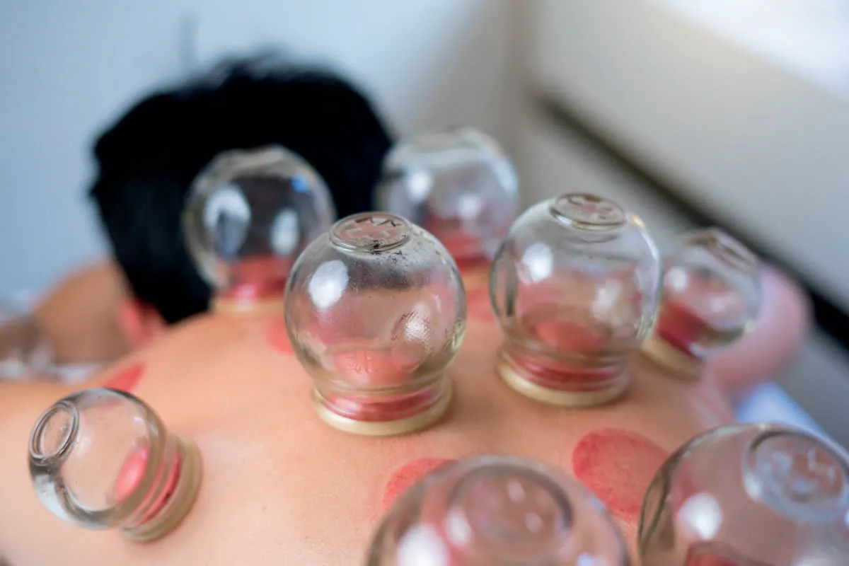 Cupping Therapy Near me