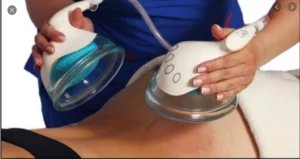 Vacuum Cupping Therapy for Back Pain & Sciatica