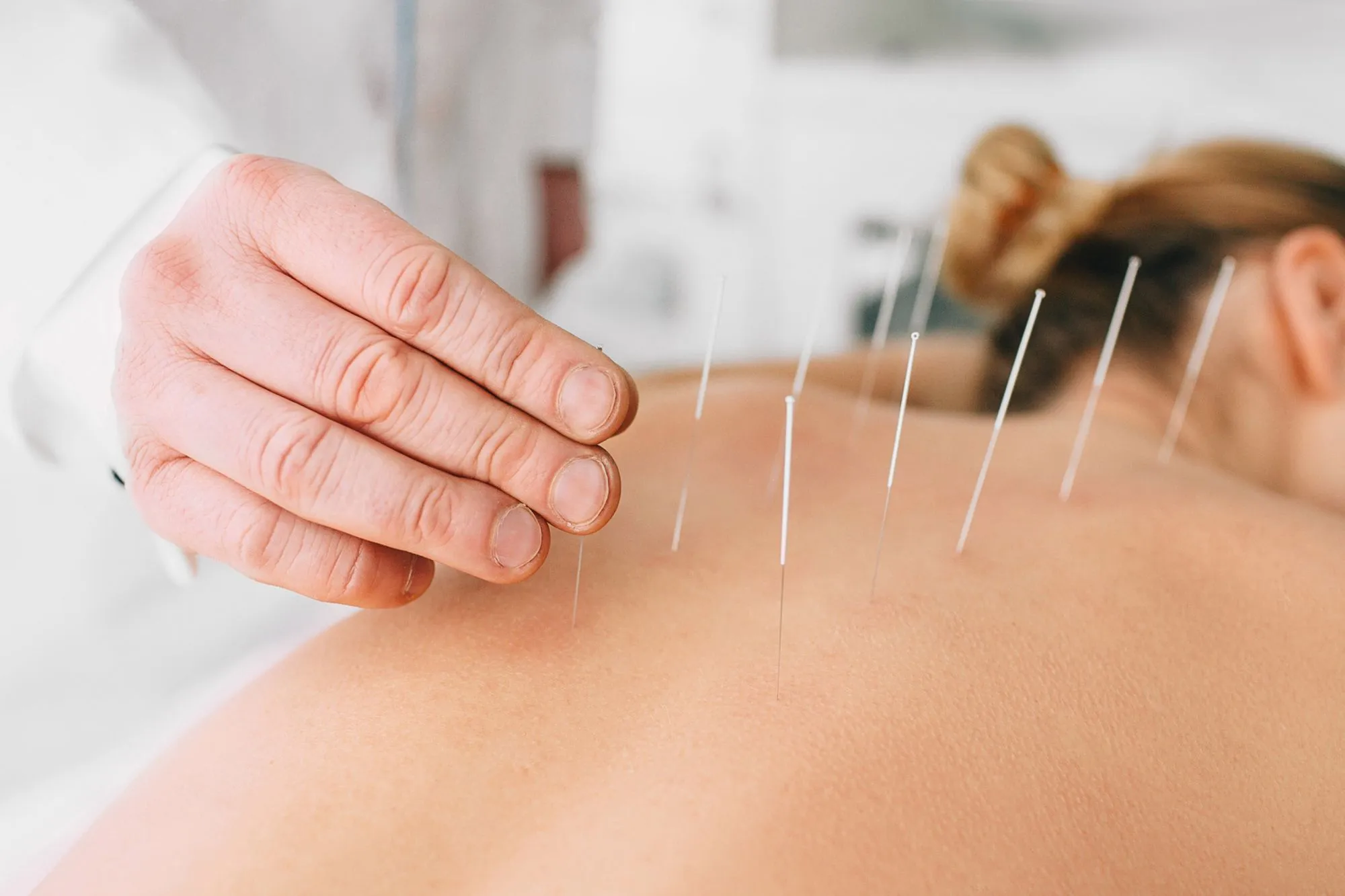Treatments by Acupuncture Near You in Bangalore